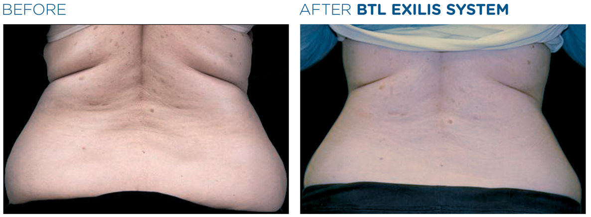 lemon-bottle-before-after-2