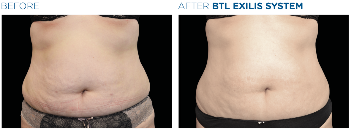 lemon-bottle-before-after-3