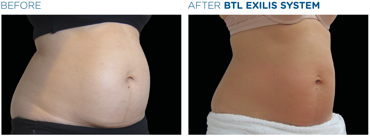 lemon-bottle-before-after-4