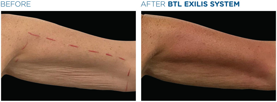 lemon-bottle-before-after-5