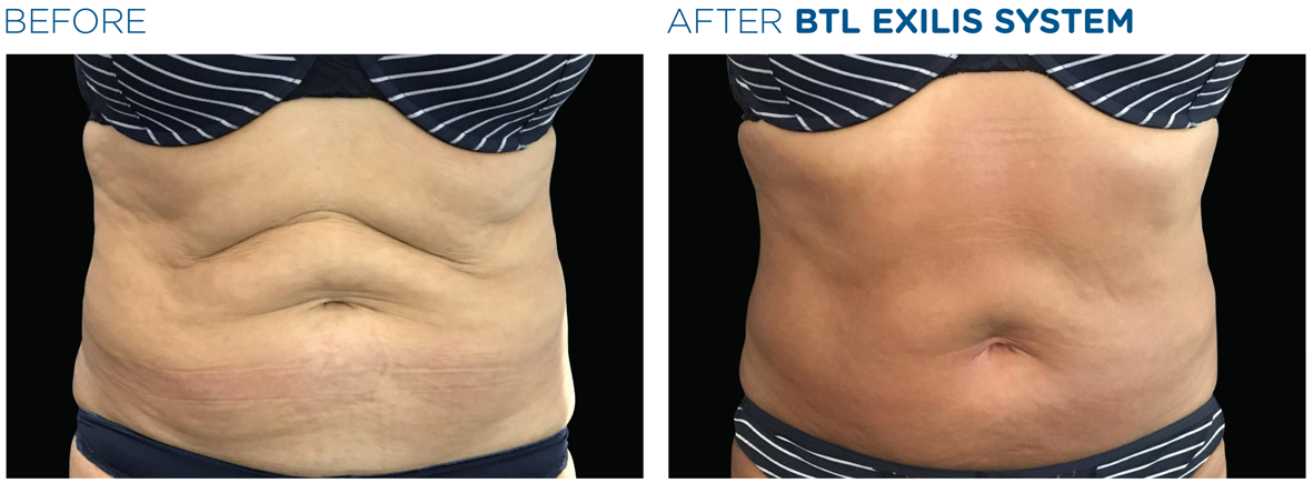 lemon-bottle-before-after-6