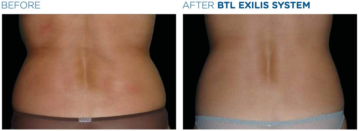 lemon-bottle-before-after