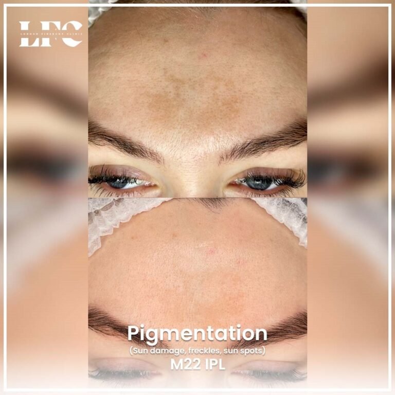 pigmentation-treatment-in-london