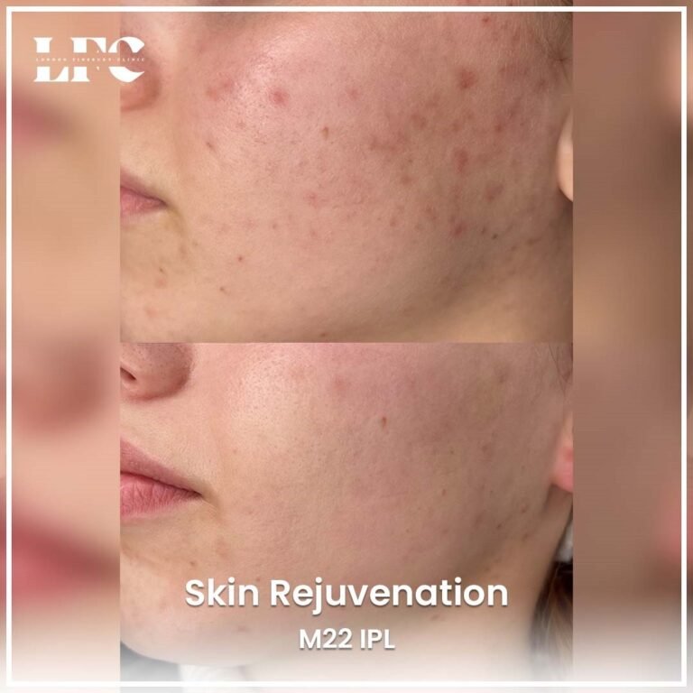 skin-rejuvenation-in-london