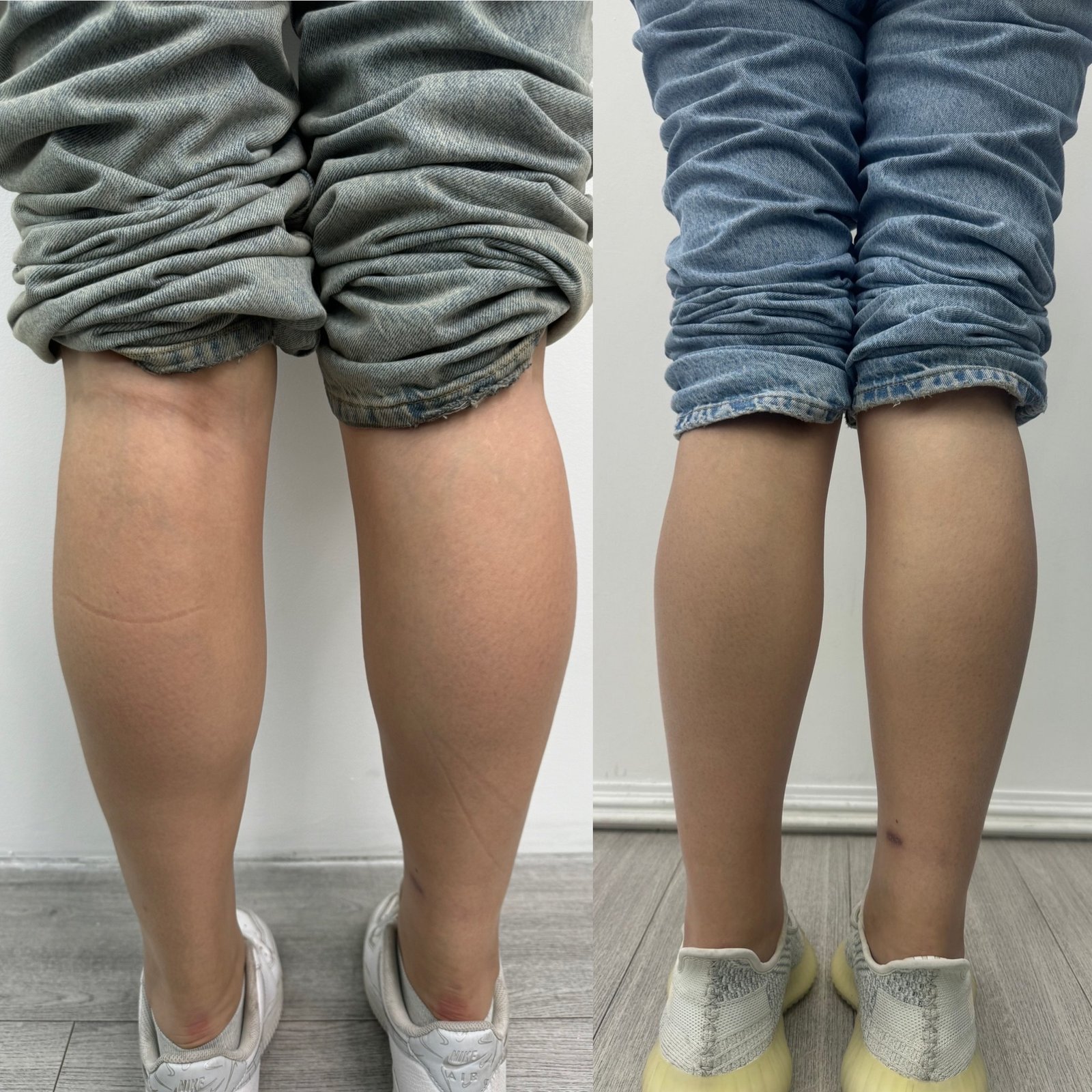 calves-slimming-before-after-london-finsbury-clinic-in-london-uk
