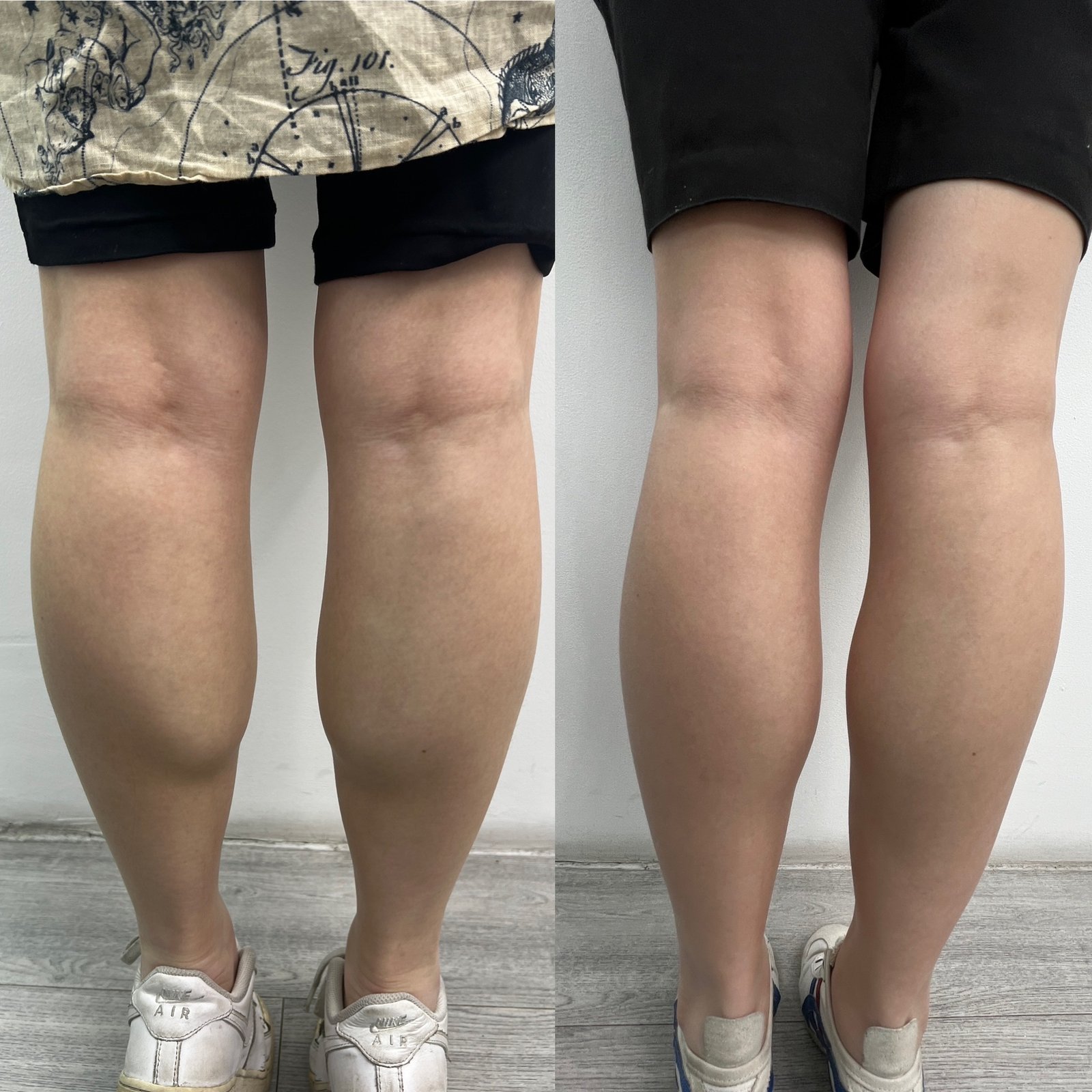 calves-slimming-before-after-london-finsbury-clinic-in-london