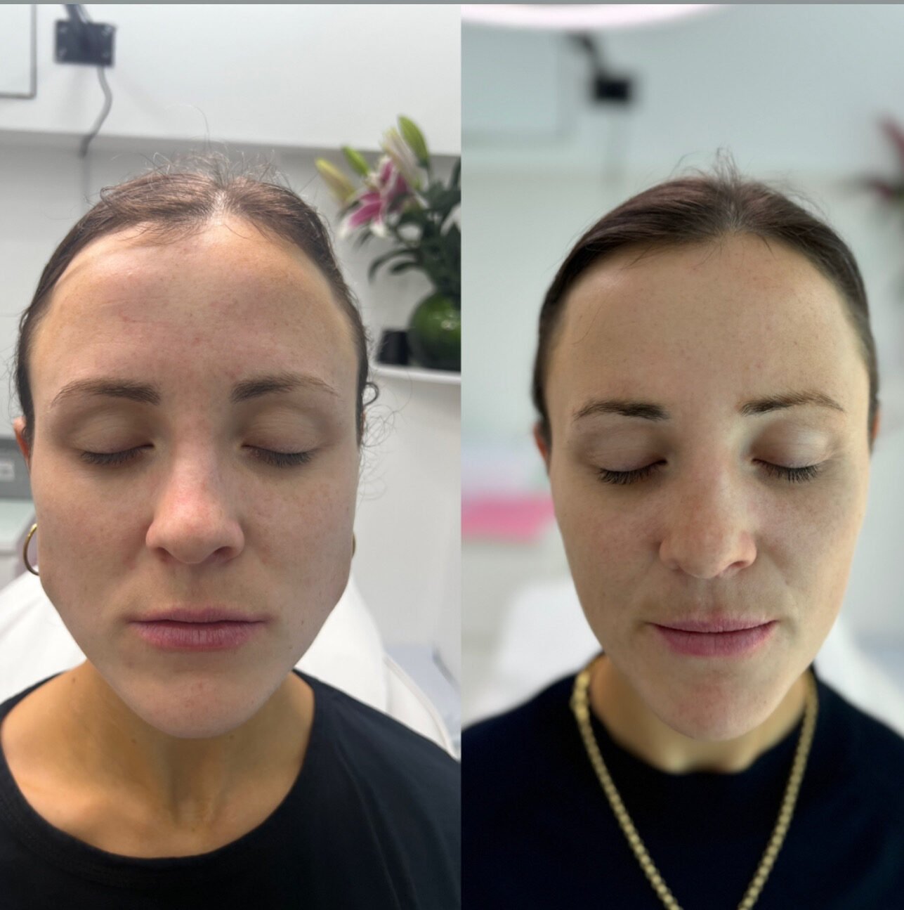 masseter-slimming-treatment-in-london