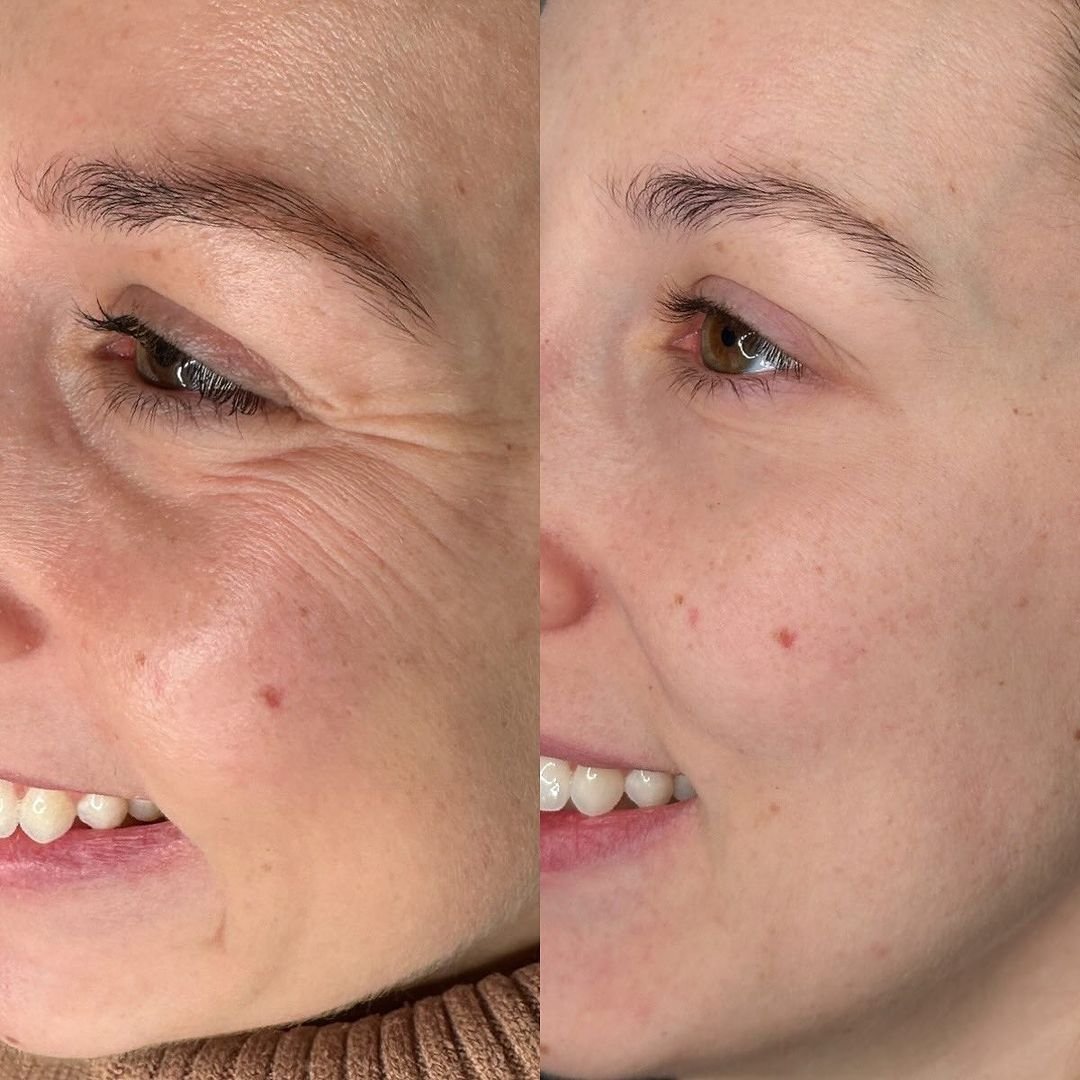 best-crows-feet-london-finsbury-clinic