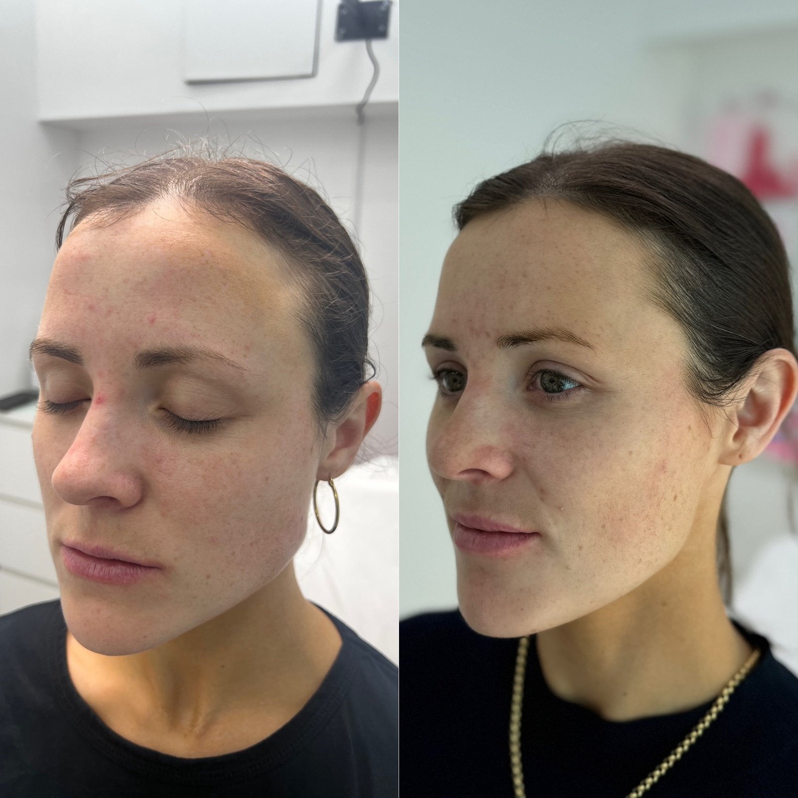 best-masseter-slimming-treatment-before-after-london-finsbury-clinic-in-london-uk