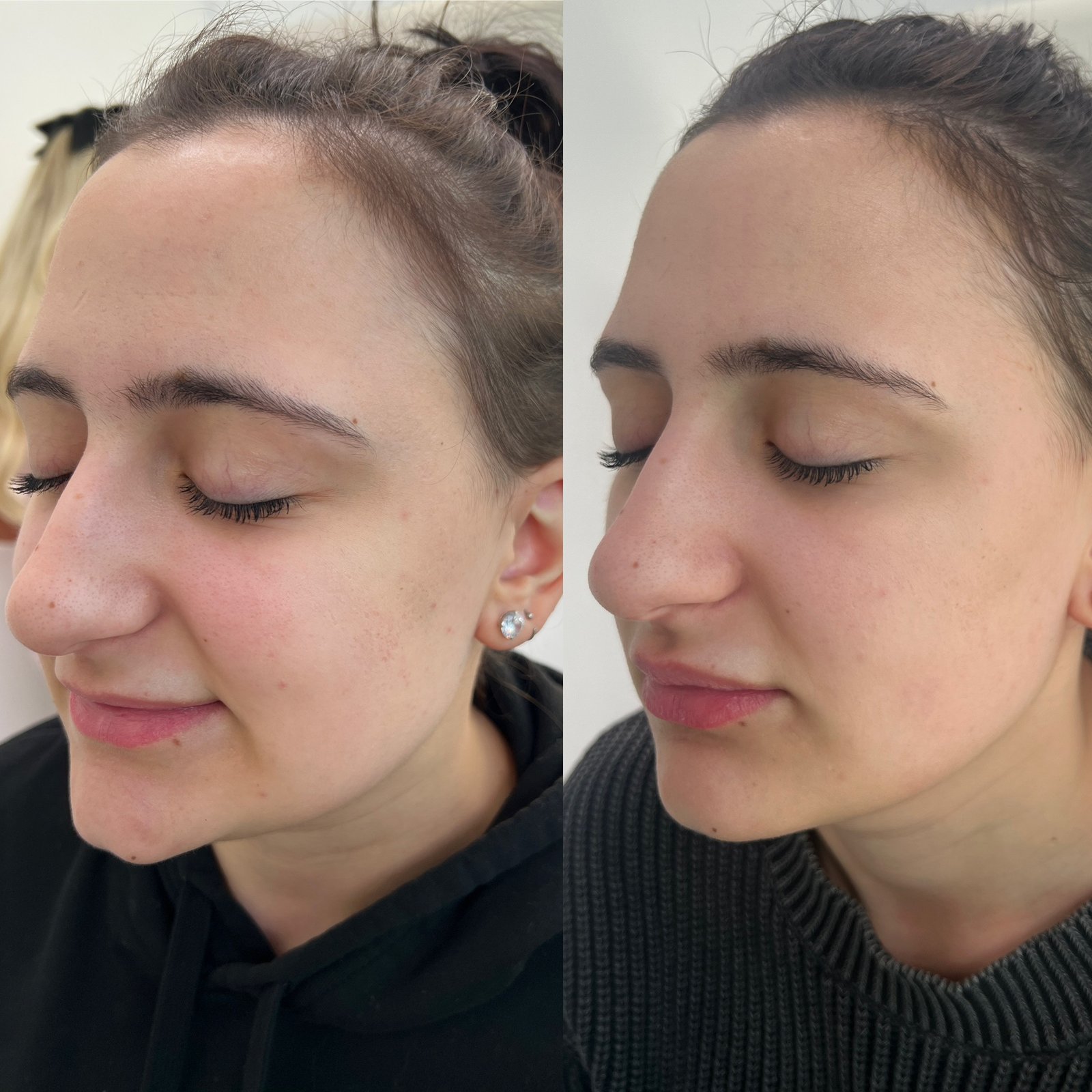 masseter-slimming-treatment-before-after-london-finsbury-clinic-in-london-uk