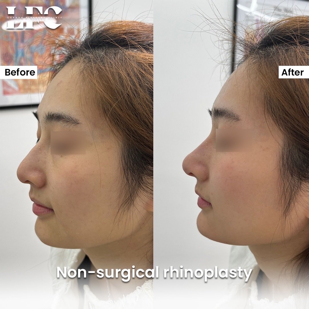 the-best-non-surgical-rhinoplasty-treatment-in-london-clinic