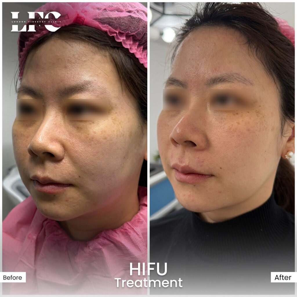 Before and After HIFU