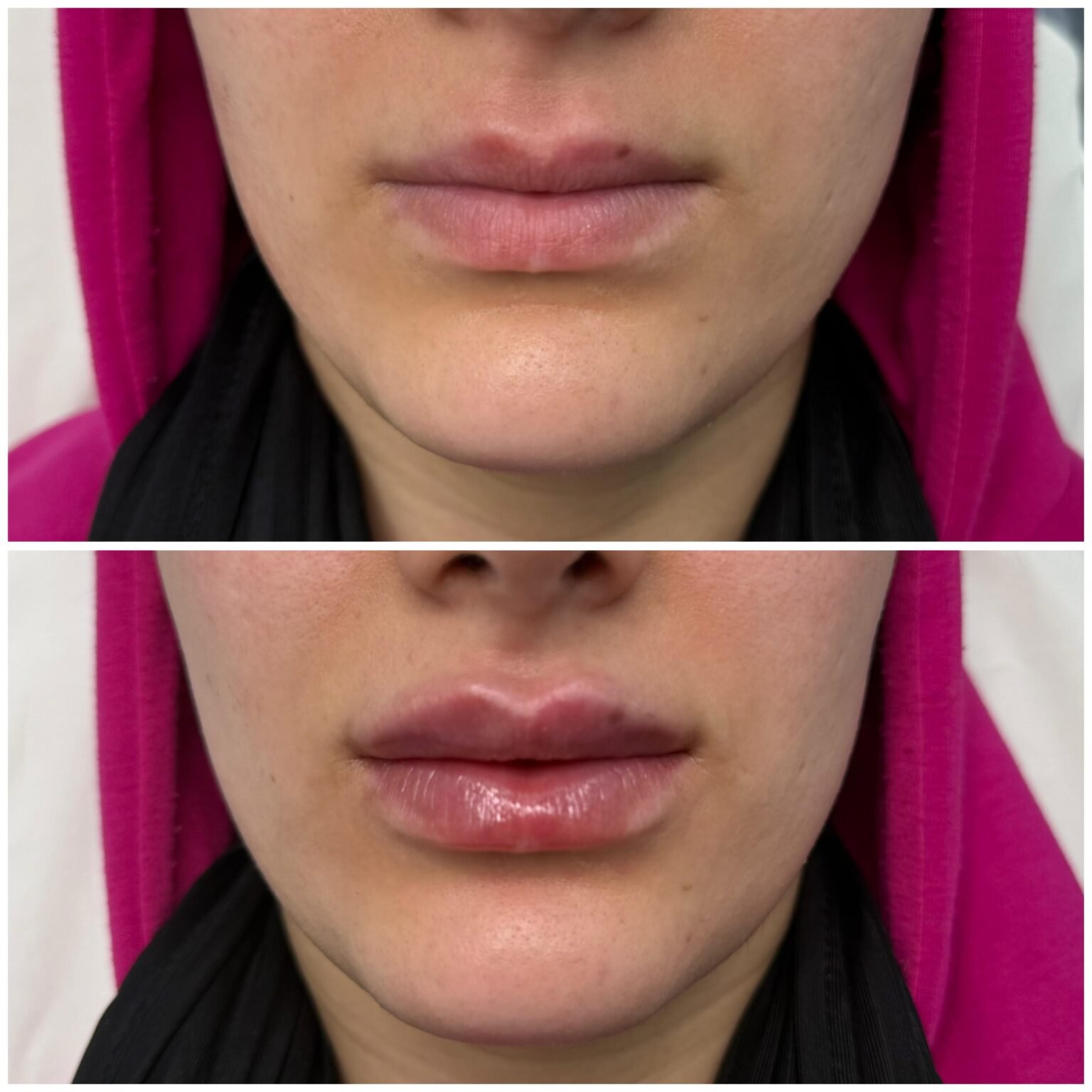 Lip Filler 2125