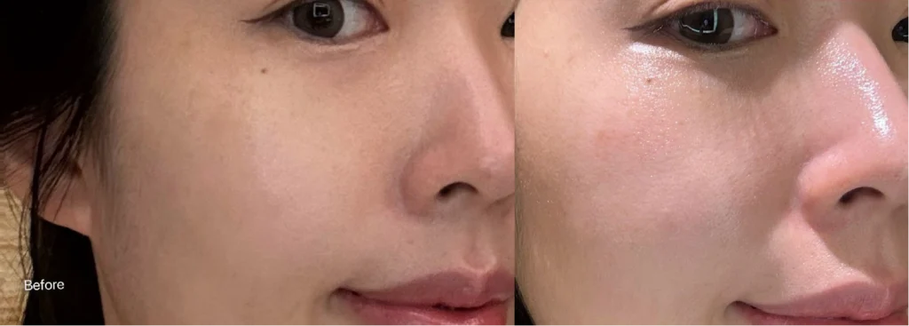 Rejuran before and after