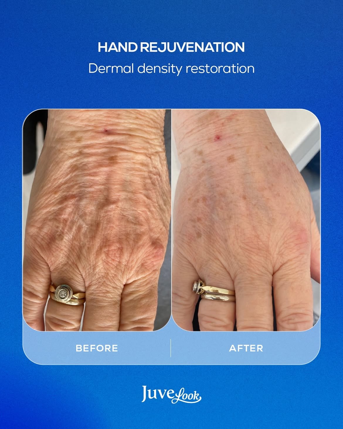 Juvelook hand rejuvenation before and after