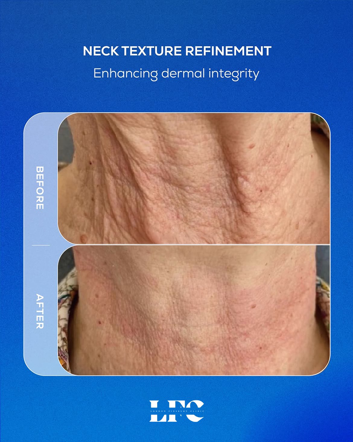 Juvelook neck treatment before and after