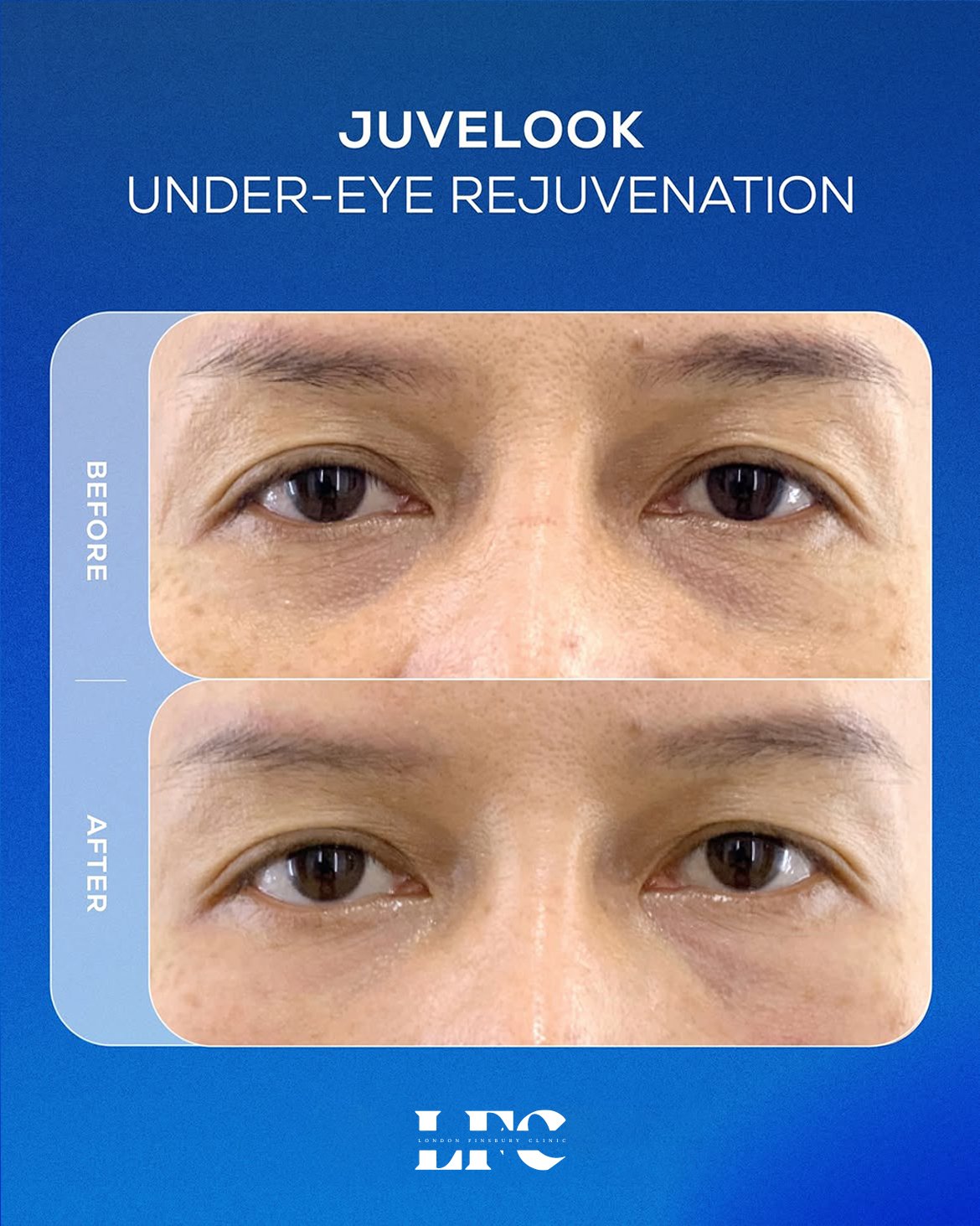 Juvelook under eye before and after
