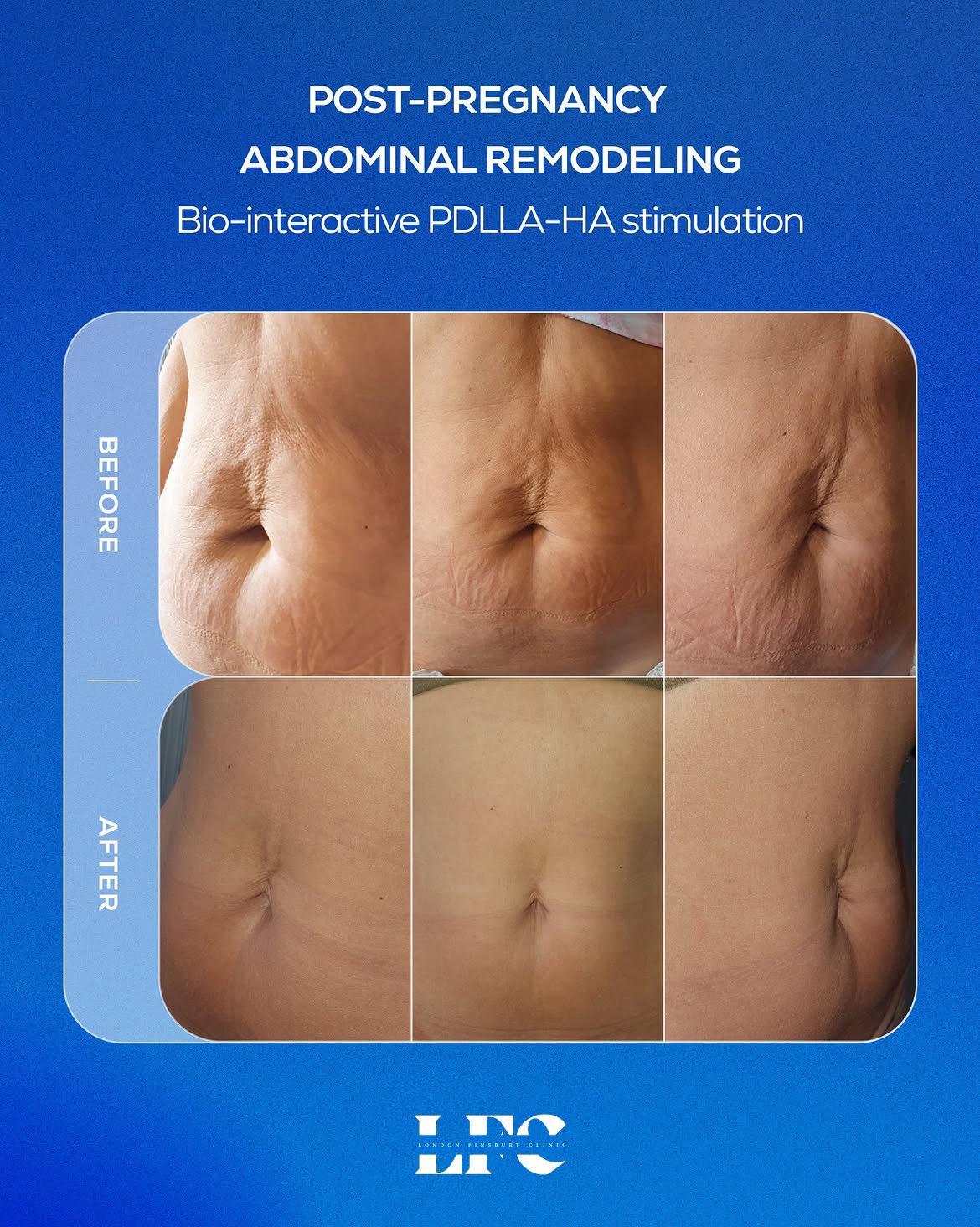 Lenisna abdominal treatment before and after