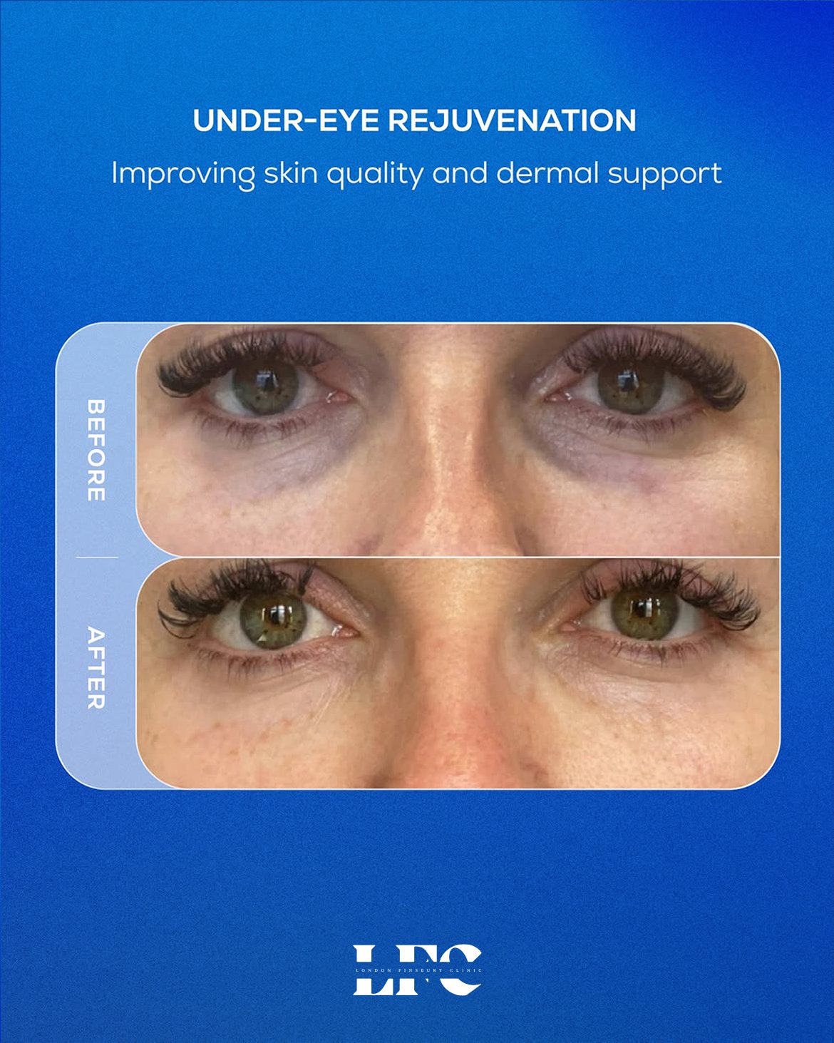Under eye rejuvenation before and after