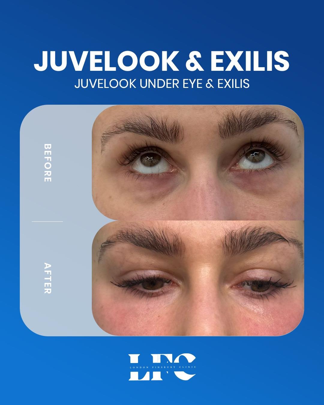 Juvelook and Exilis under-eye before and after result