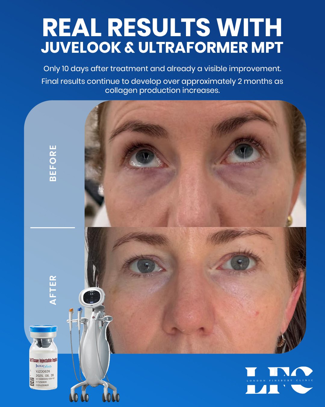 London Finsbury Clinic result: before and 10 days after Juvelook under eyes combined with Ultraformer MPT Eye Booster Tip