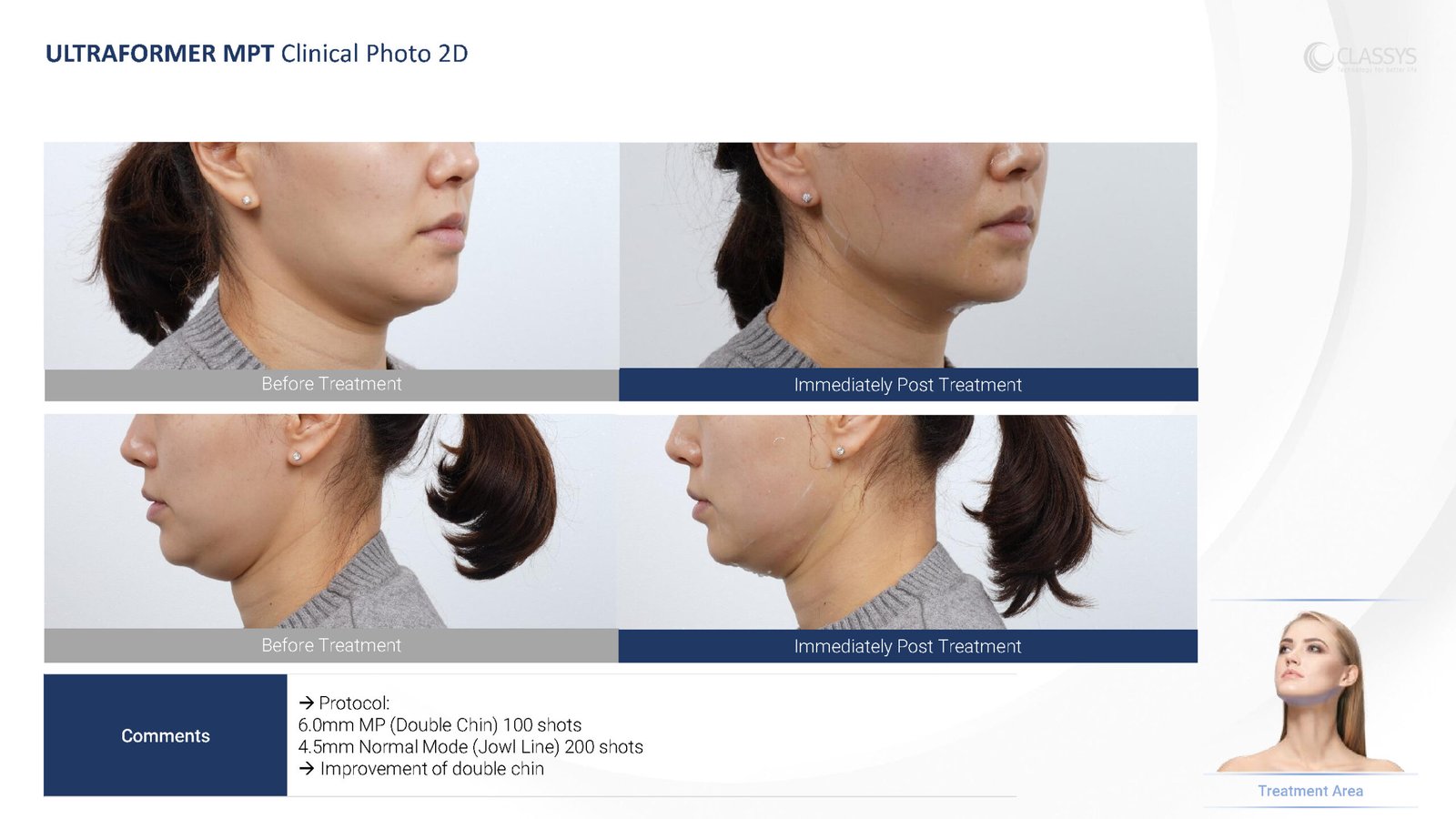 CLASSYS Ultraformer MPT clinical example. Double chin: before and immediately after treatment.