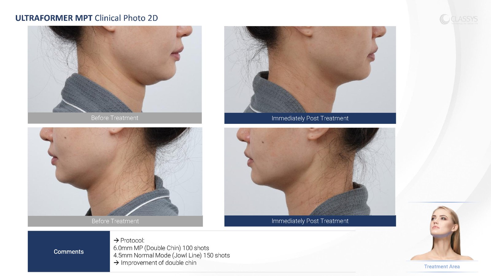 CLASSYS Ultraformer MPT clinical example. Double chin: before and immediately after treatment.