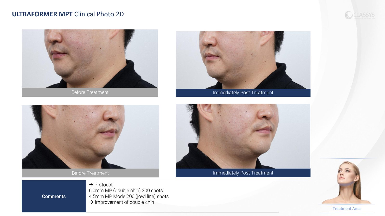 CLASSYS Ultraformer MPT clinical example. Male double chin: before and immediately after treatment.