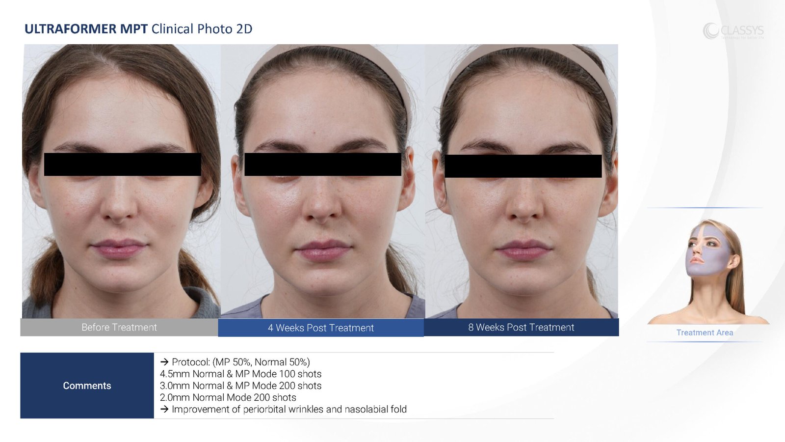 CLASSYS Ultraformer MPT clinical example. Face: before, 4 weeks and 8 weeks after treatment.