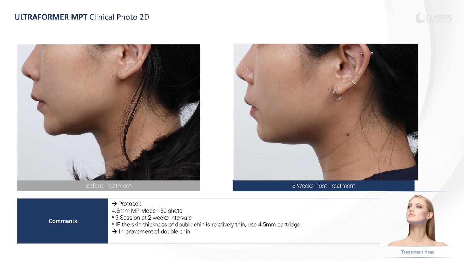 CLASSYS Ultraformer MPT clinical example. Double chin: 6 weeks; three sessions at two-week intervals.
