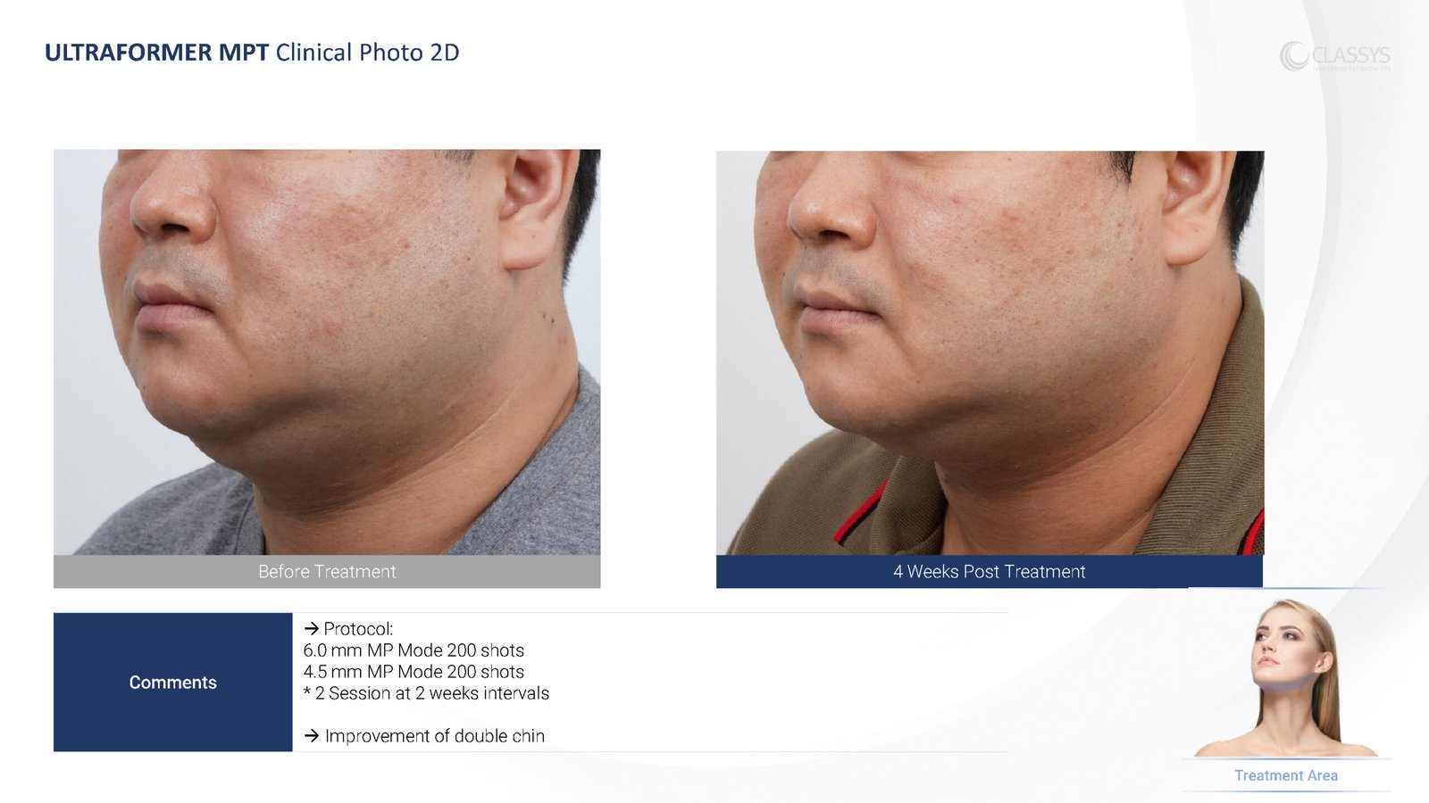 CLASSYS Ultraformer MPT clinical example. Male double chin: 4 weeks; two sessions at two-week intervals.