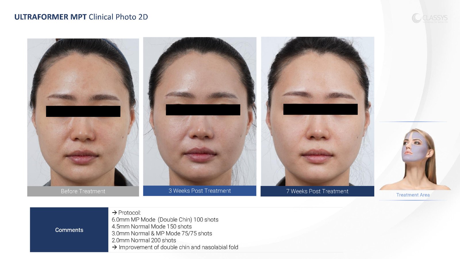 CLASSYS Ultraformer MPT clinical example. Face: before, 3 weeks and 7 weeks after treatment.
