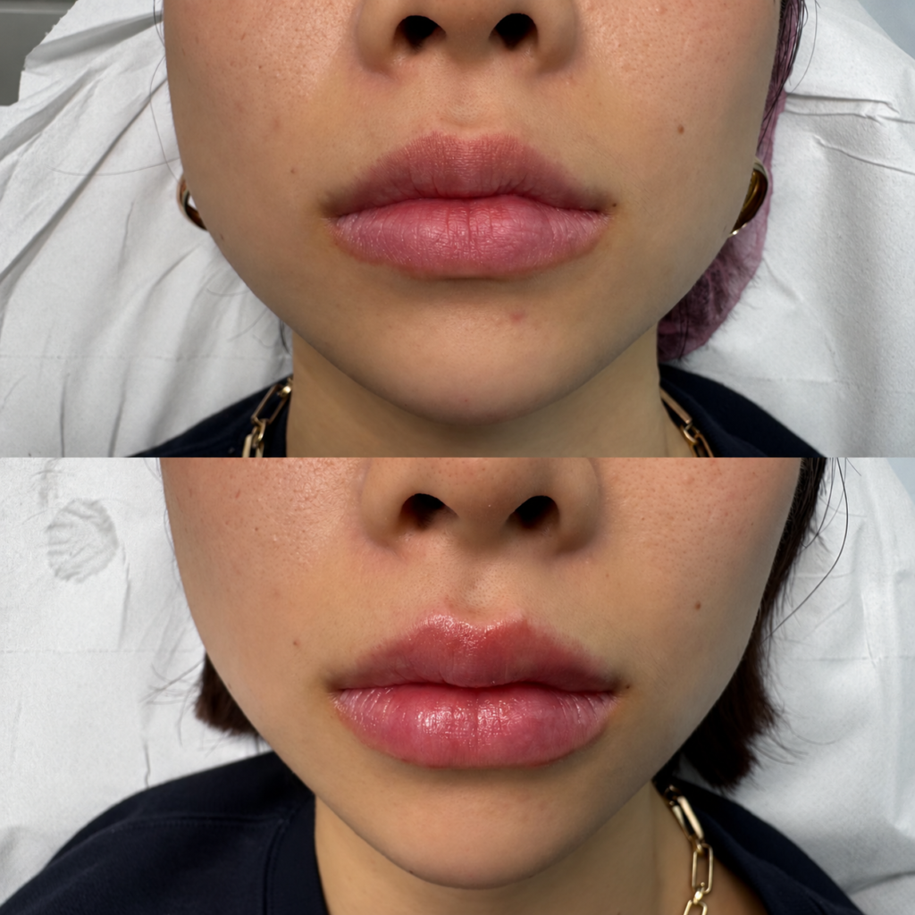 Lip filler — case 1 at London Finsbury Clinic: Juvéderm Ultra Smile, before above and after below