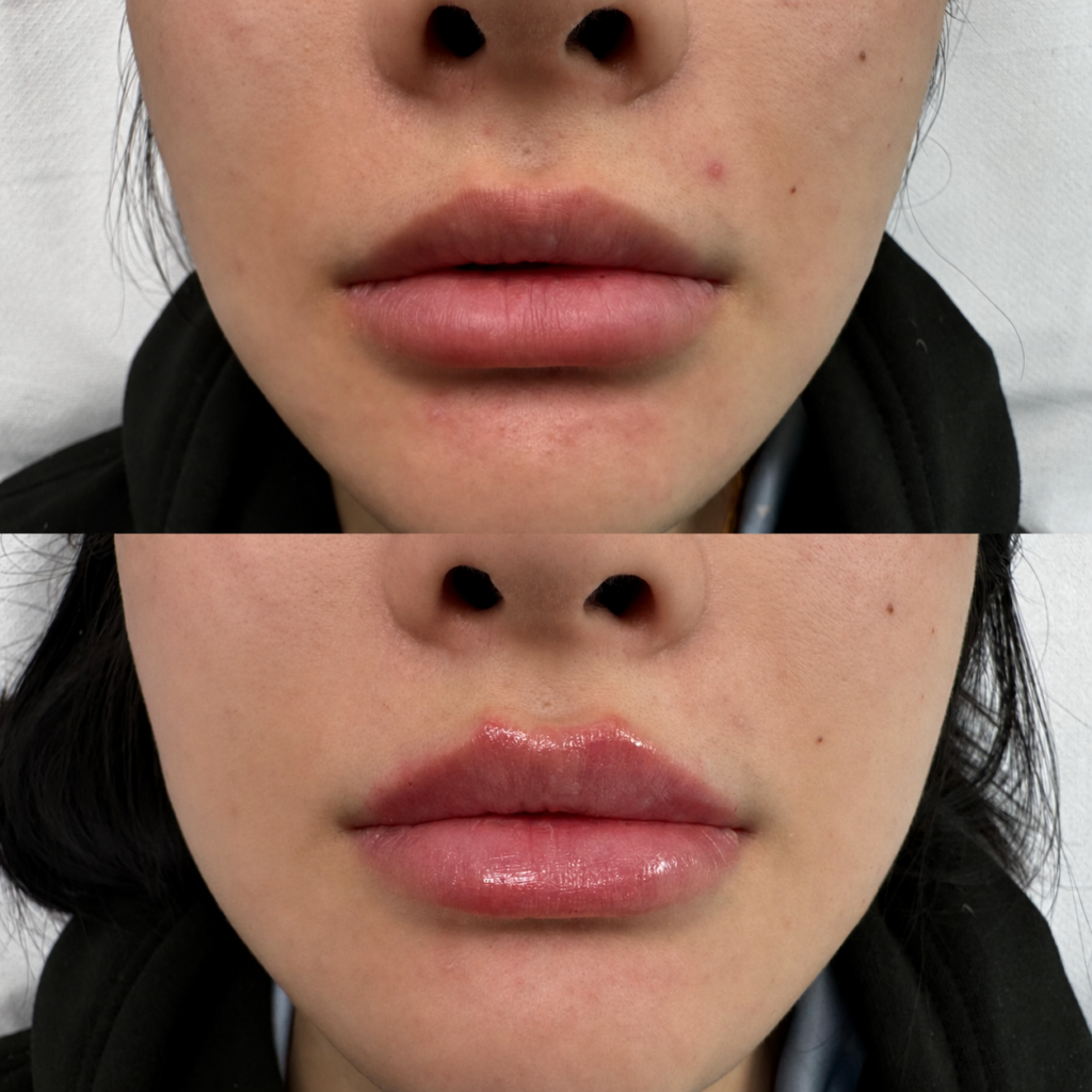Lip filler — case 2 at London Finsbury Clinic: Juvéderm Ultra Smile, before above and after below