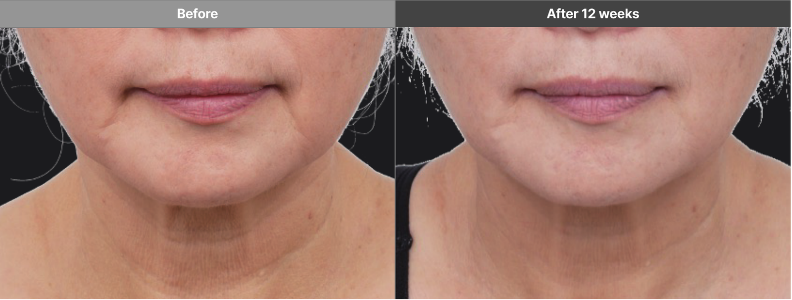 Volformer manufacturer case: lower face before and after 12 weeks