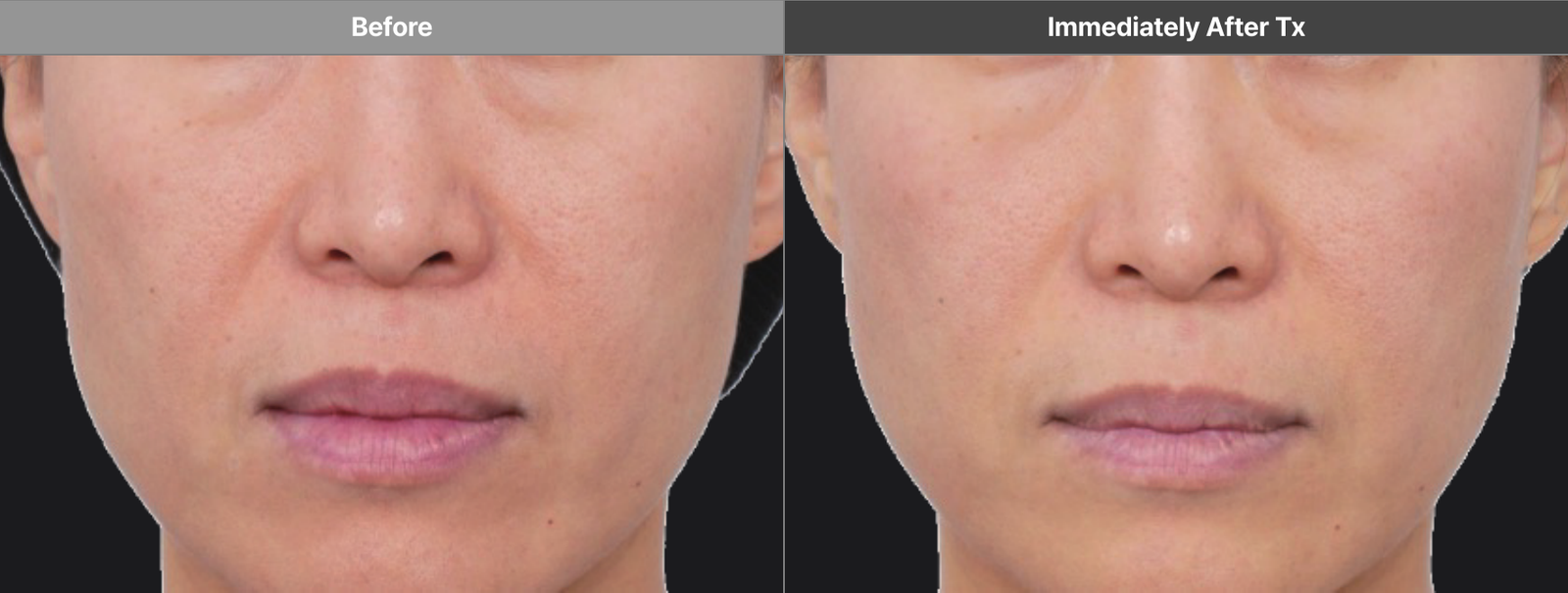 Volformer cheeks manufacturer case before and immediately after treatment