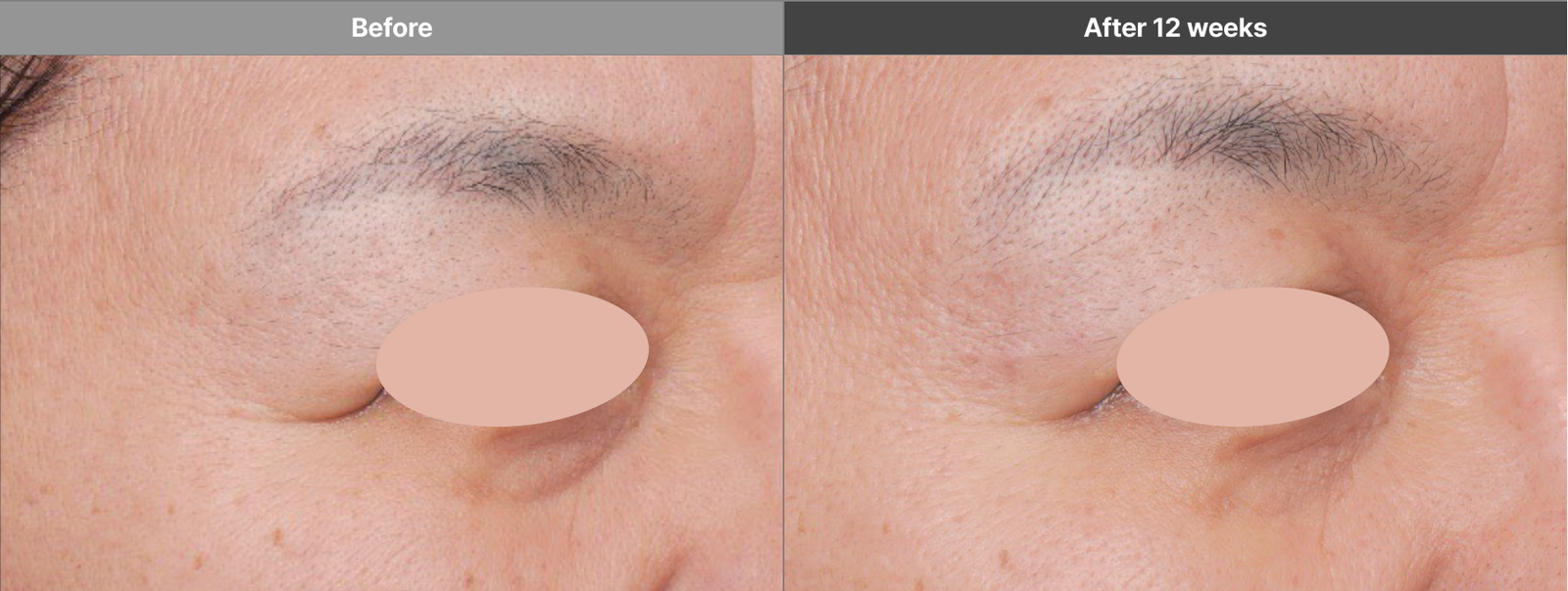 Volformer selected eye-area manufacturer case before and after 12 weeks