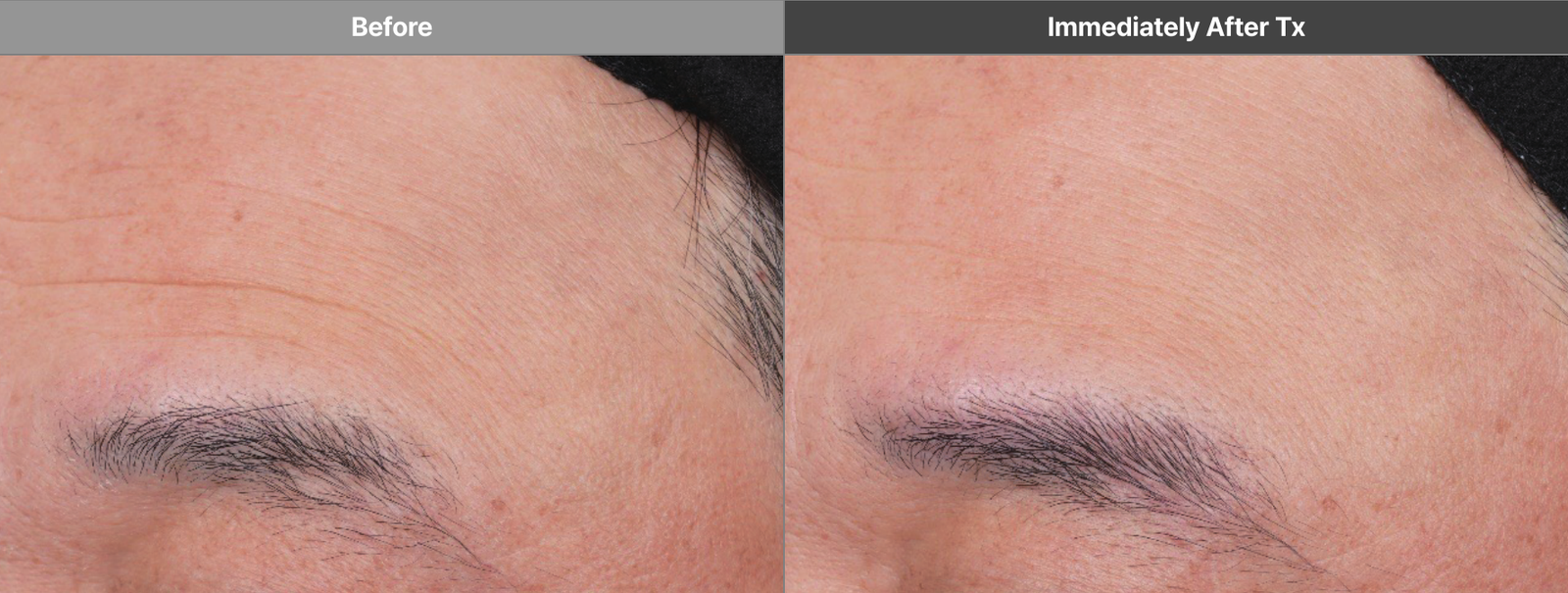 Volformer forehead manufacturer case before and immediately after treatment