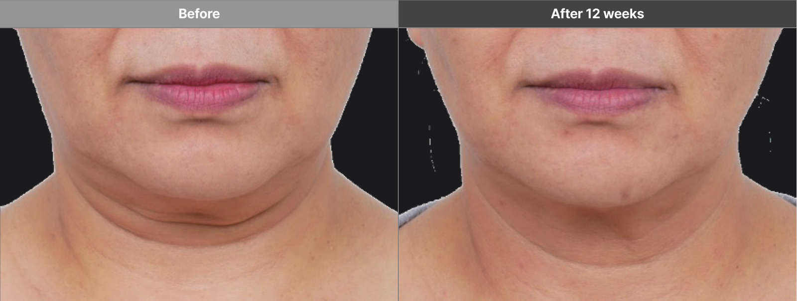 Volformer intensive manufacturer case before and after 12 weeks