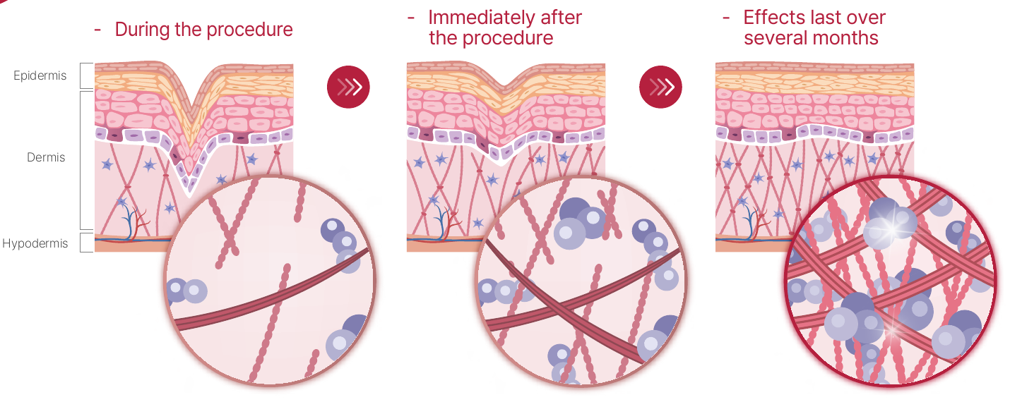 CLASSYS illustration of collagen remodelling during treatment and over the following months