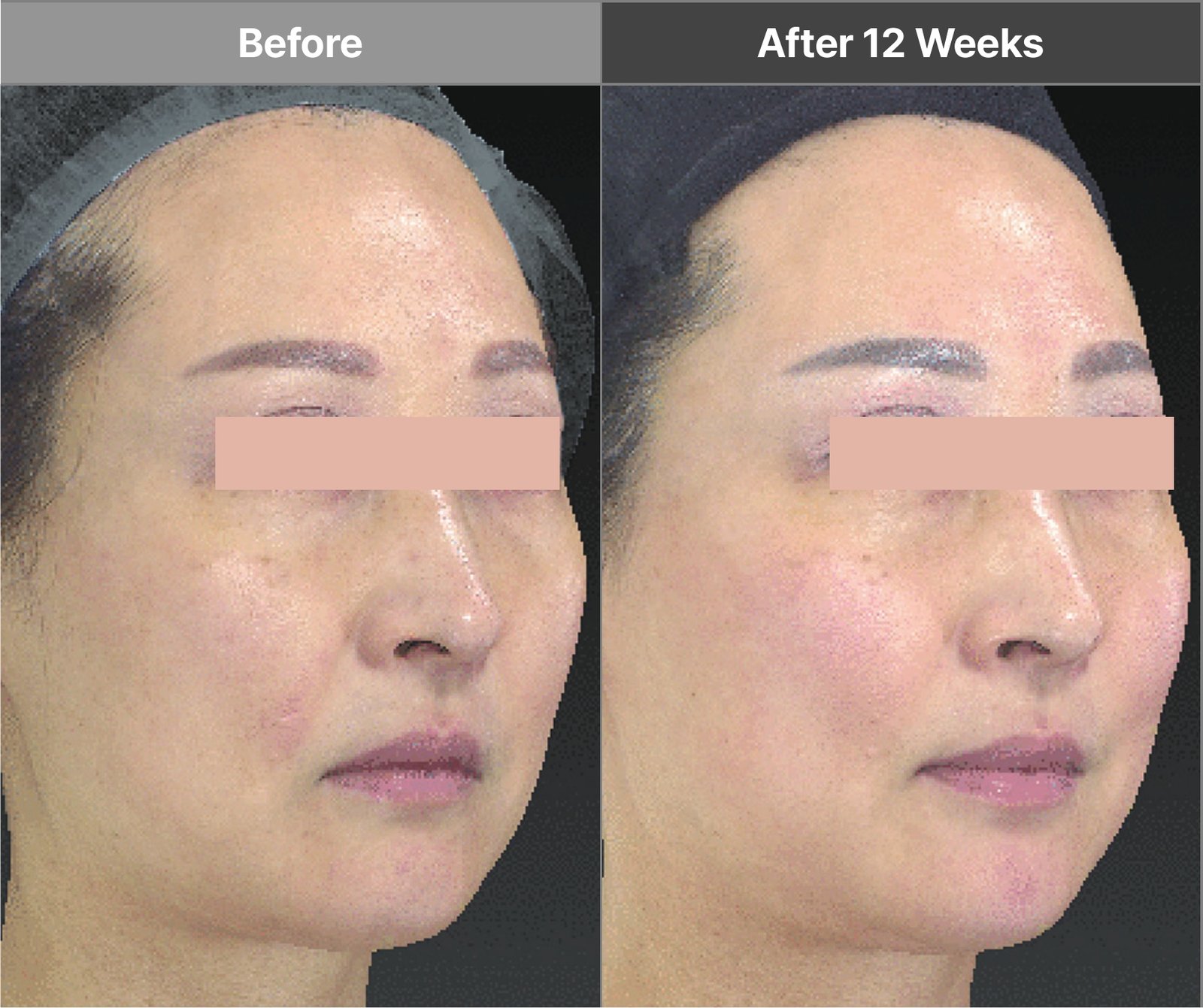 Volnewmer full-face F and I-tip case before and after 12 weeks