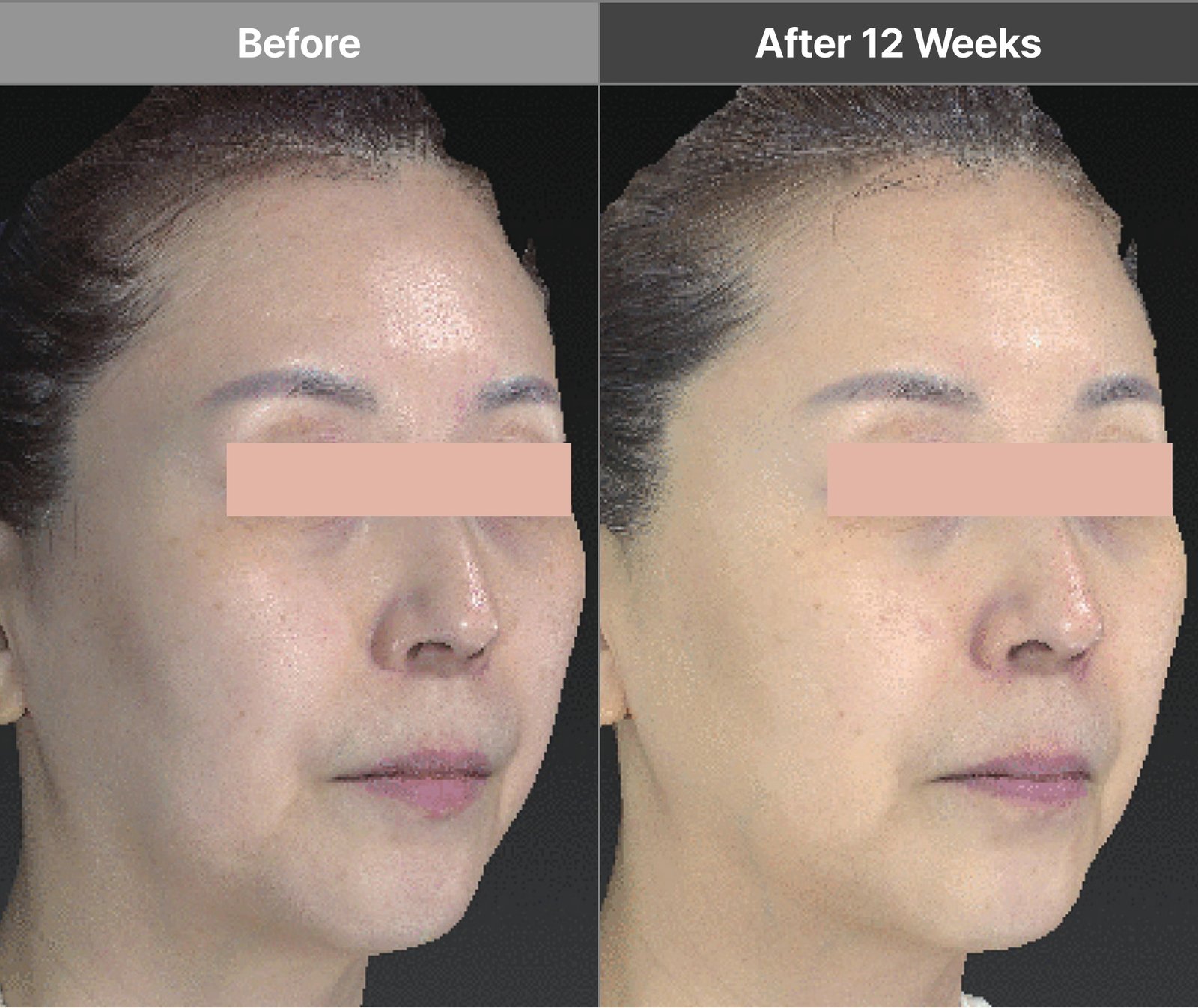 Volnewmer full-face F-tip case before and after 12 weeks