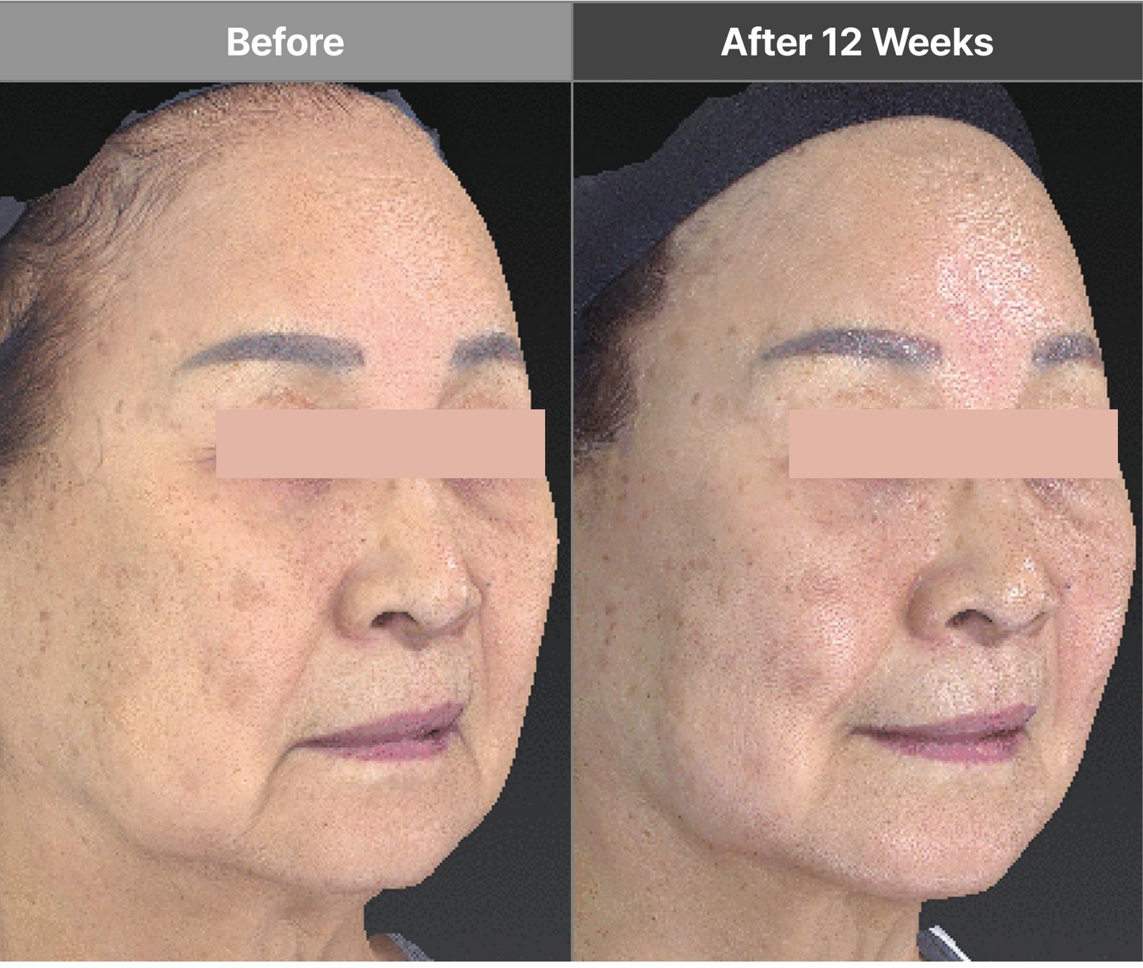 Volnewmer full-face multi-tip case before and after 12 weeks