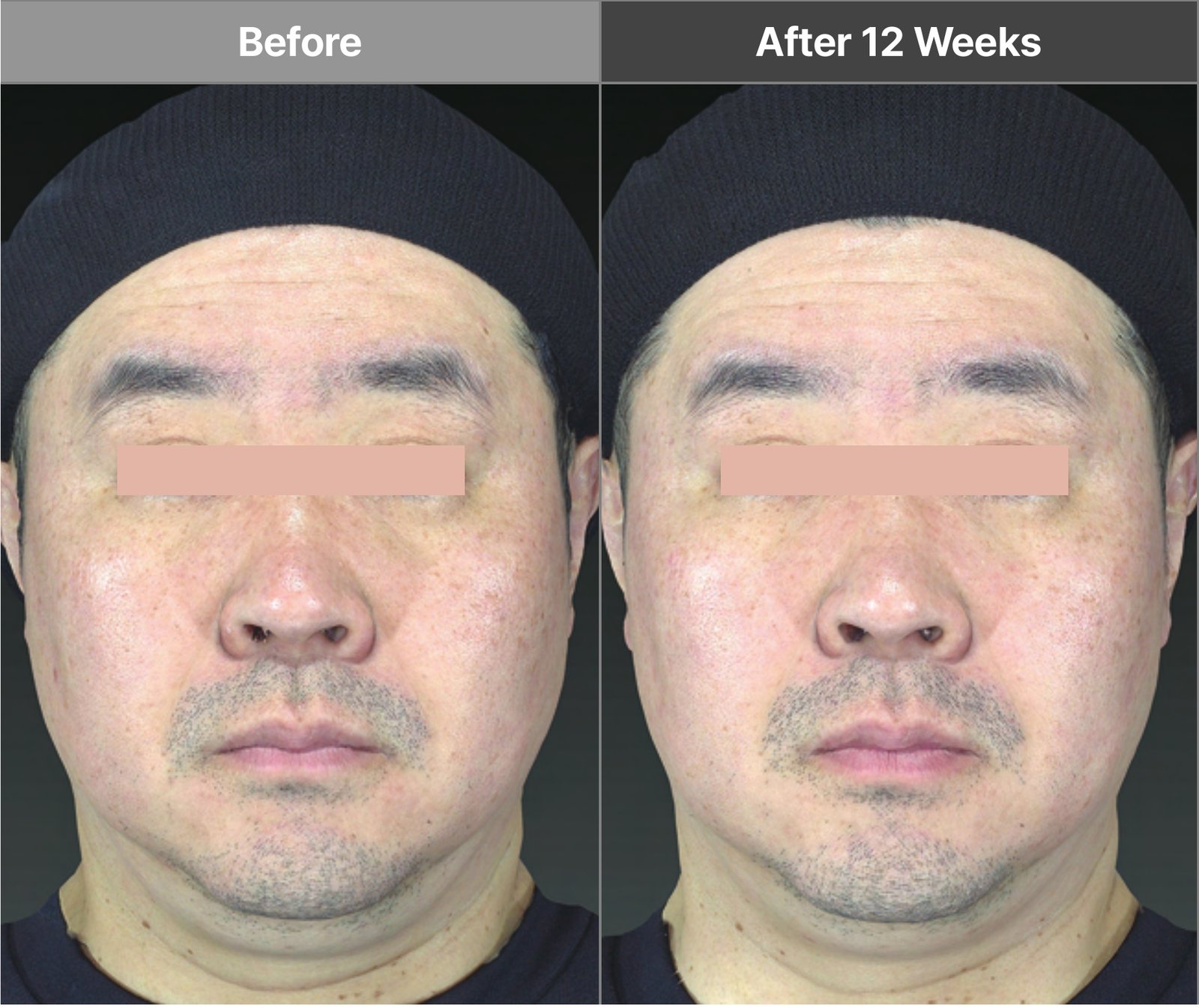 Volnewmer full-face male V-tip case before and after 12 weeks