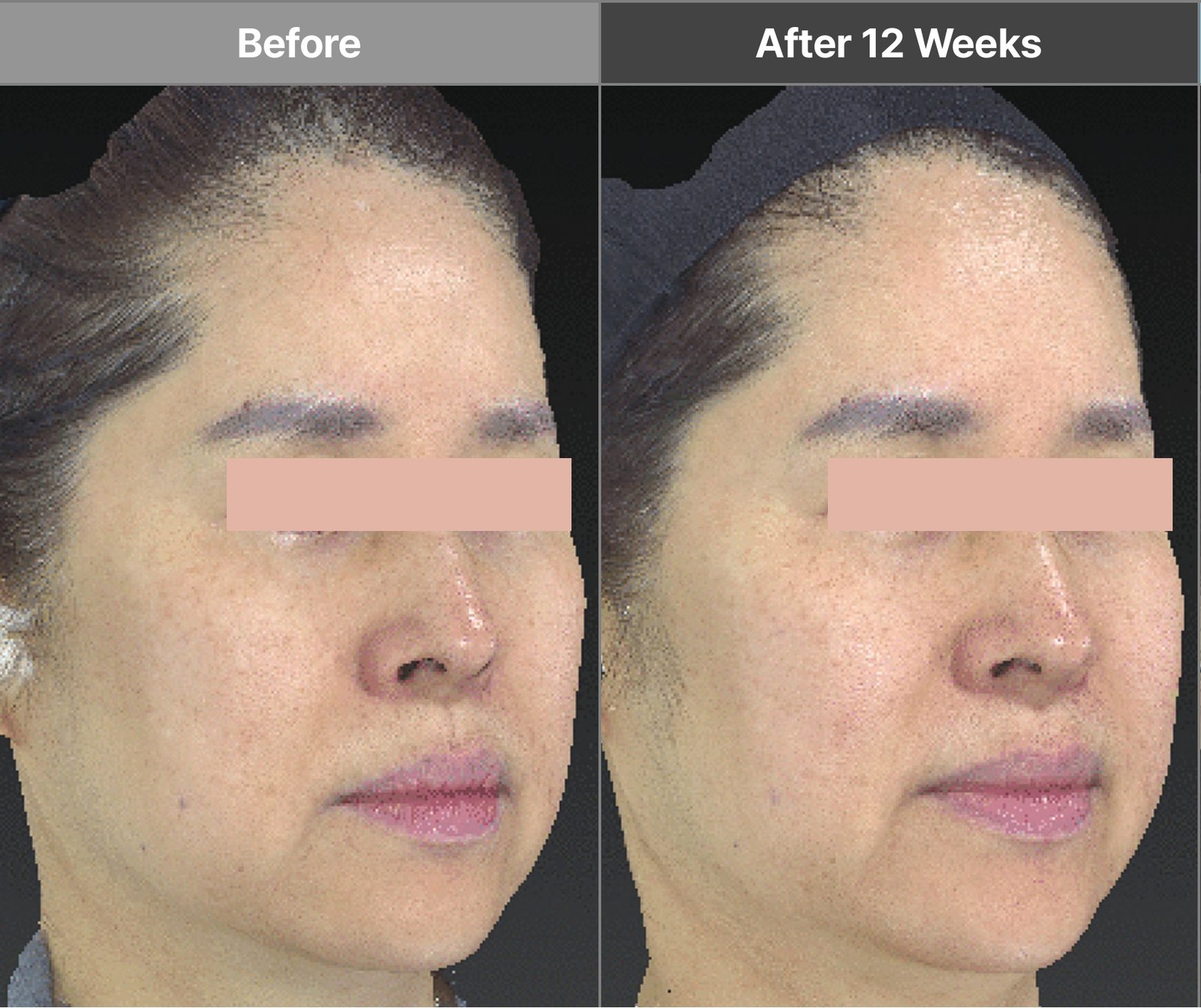 Volnewmer full-face V and I-tip case before and after 12 weeks