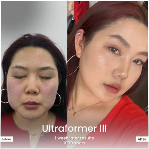 Before and After ultraformer lll