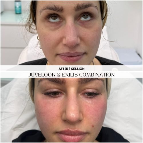 Juvelook Before & After