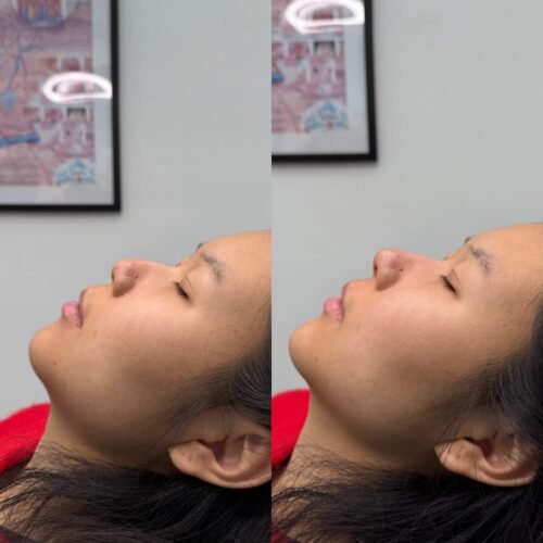 nasal base fillerkln